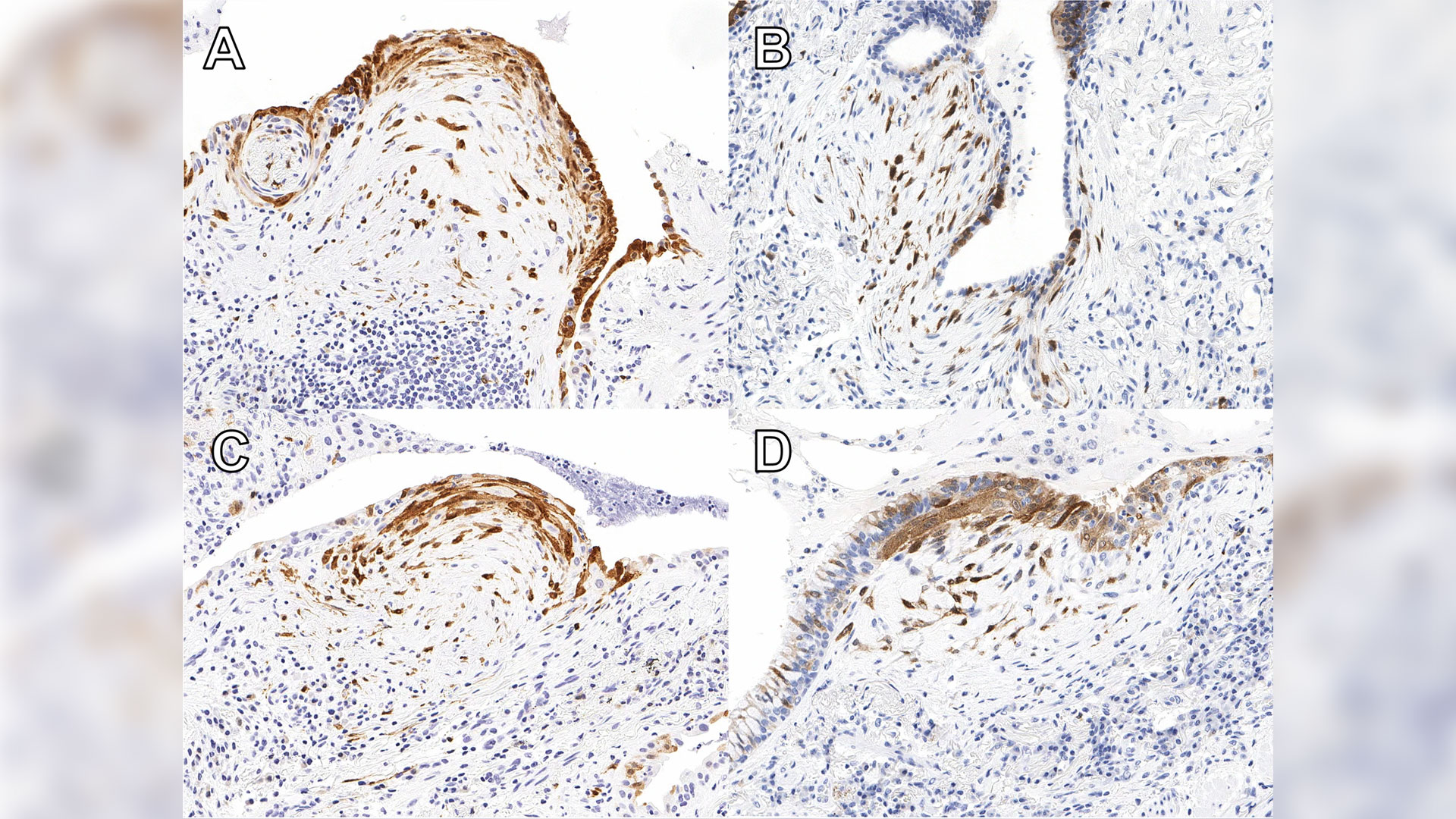 p16-positive foci were defined as concurrent expression of p16 (brown) in loose collections of fibroblasts the overlying flat (A), simple cuboidal (B and C) or columnar epithelium (D). Cases classified as p16-low had ≤ 2.1 foci per 100 mm2 lung tissue, and cases classified as p16-high had > 2.1 foci per 100 mm2 lung tissue