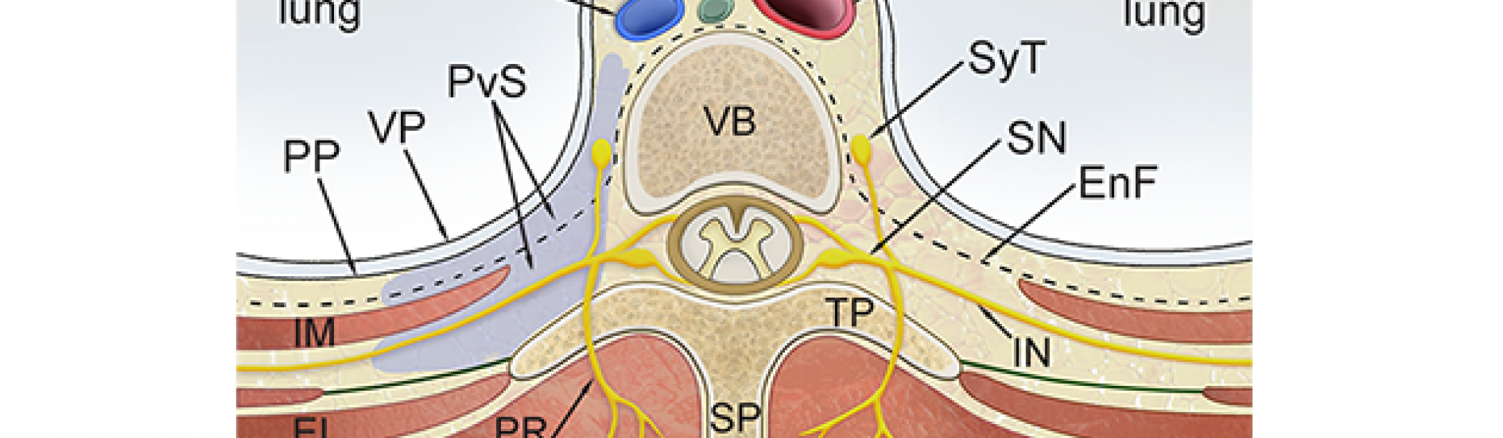 Diagram illustrating the target area for a paravertebral block