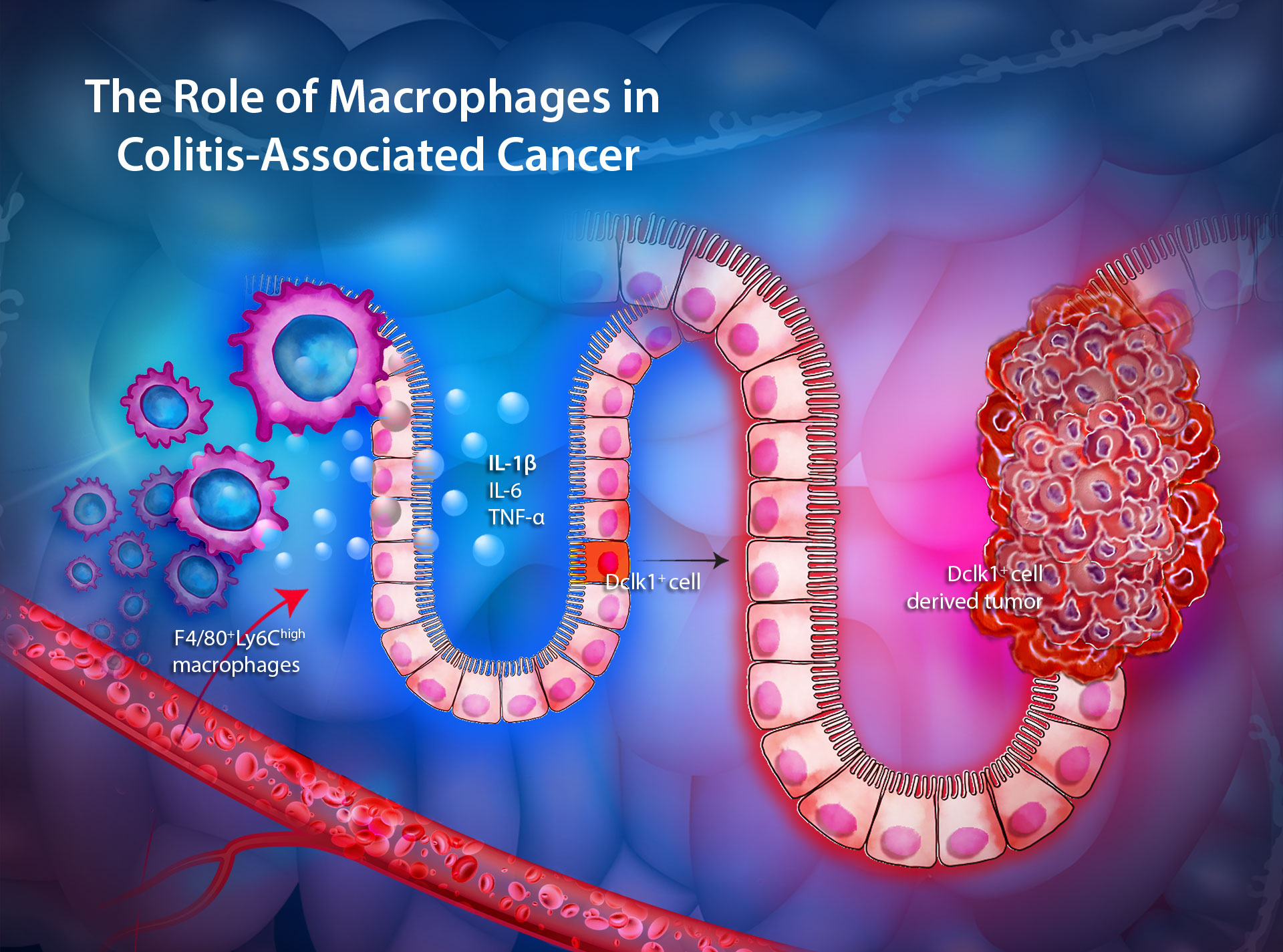 The role of macrophages in in colitis-associated cancer (Source: Gastroenterology)