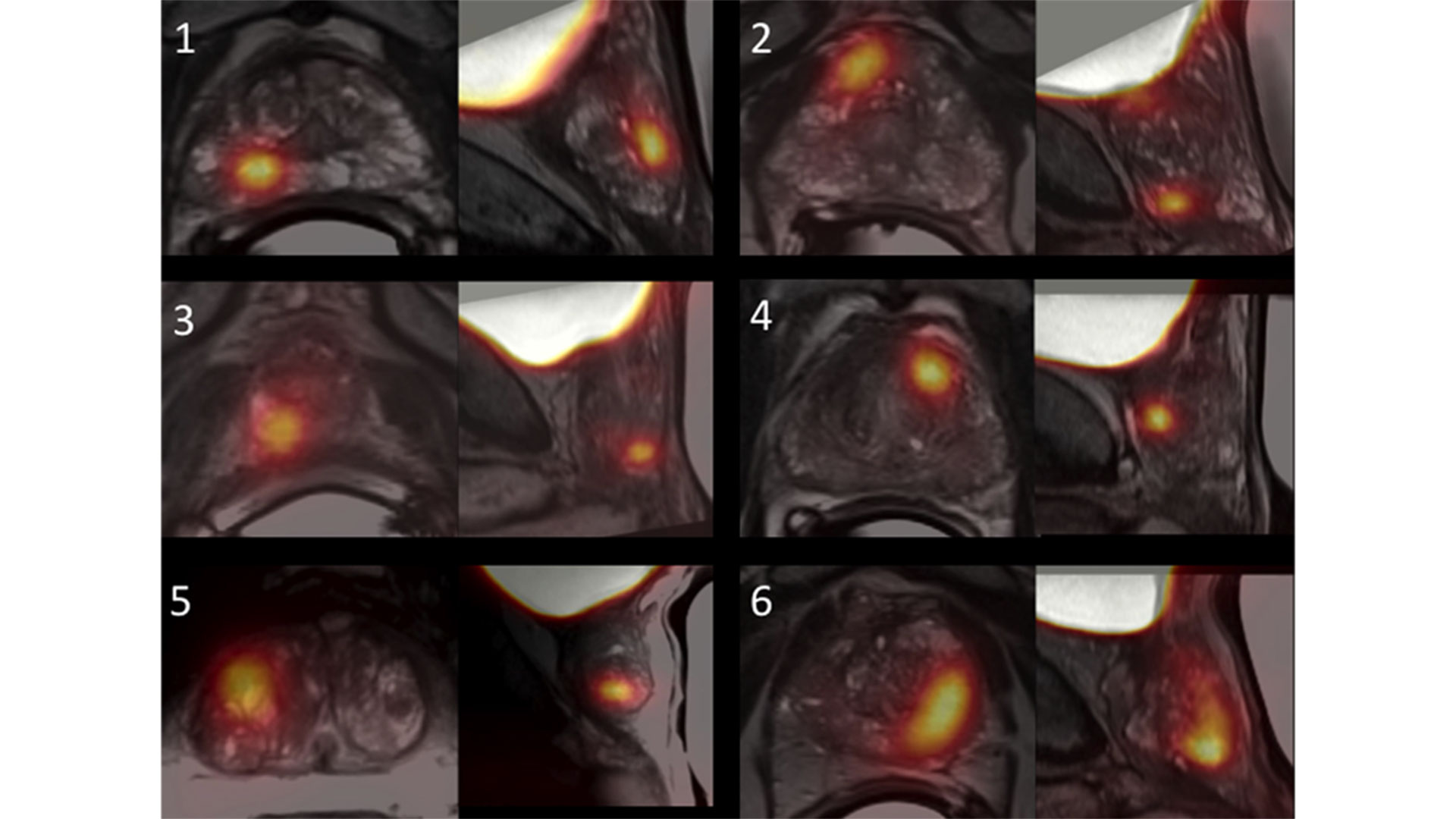 MRI and [18F]-DCFPyL PET images of six trial participants with prostate cancer.