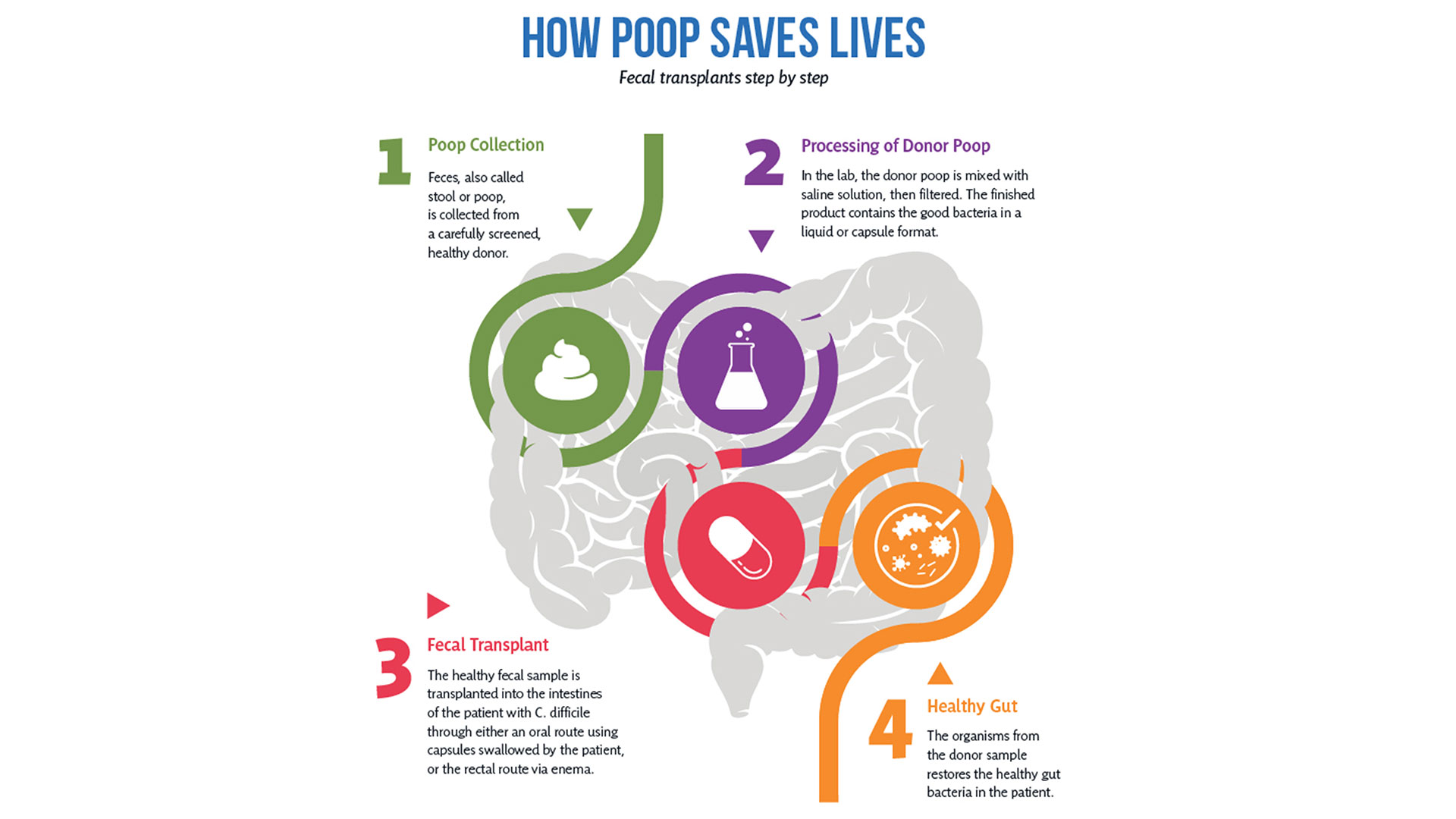 Fecal microbial transplant (FMT) graphic