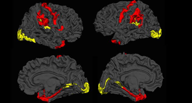Brain scans showing changes in patients with schizophrenia