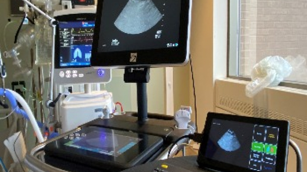 AI ultrasound in the ICU