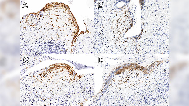 p16-positive foci were defined as concurrent expression of p16 (brown) in loose collections of fibroblasts the overlying flat (A), simple cuboidal (B and C) or columnar epithelium (D). Cases classified as p16-low had ≤ 2.1 foci per 100 mm2 lung tissue, and cases classified as p16-high had > 2.1 foci per 100 mm2 lung tissue