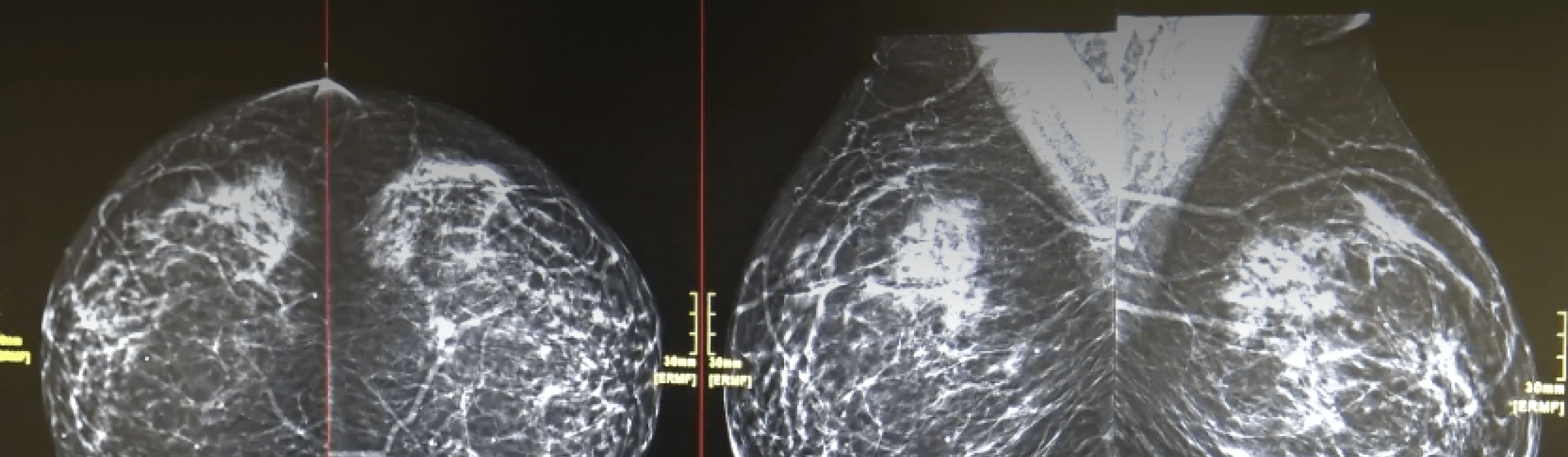 breast biopsy scan