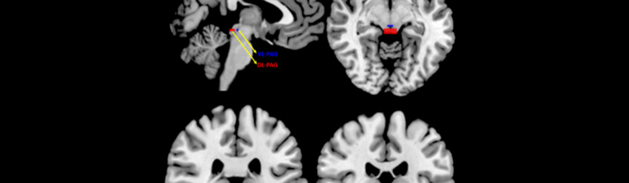 Brain scans showing the PAG region that was studied