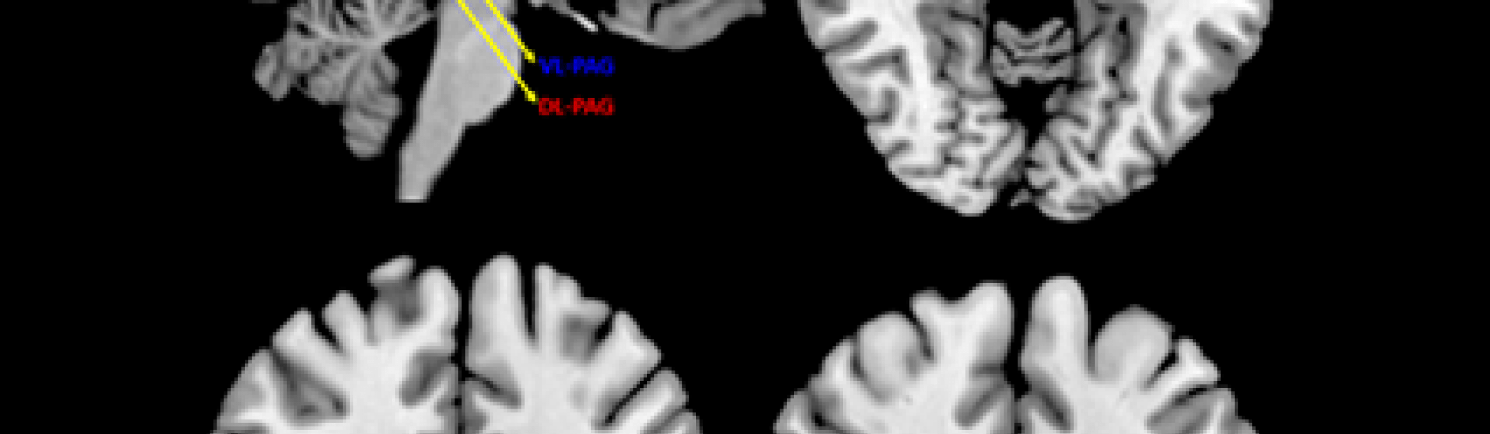 Brain scans with PAG marked