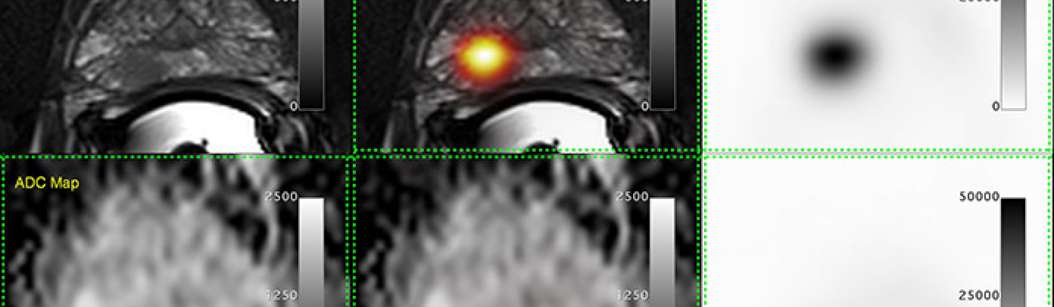 Image of PET/MRI scan showing prostate cancer that was captured using PSMA probe